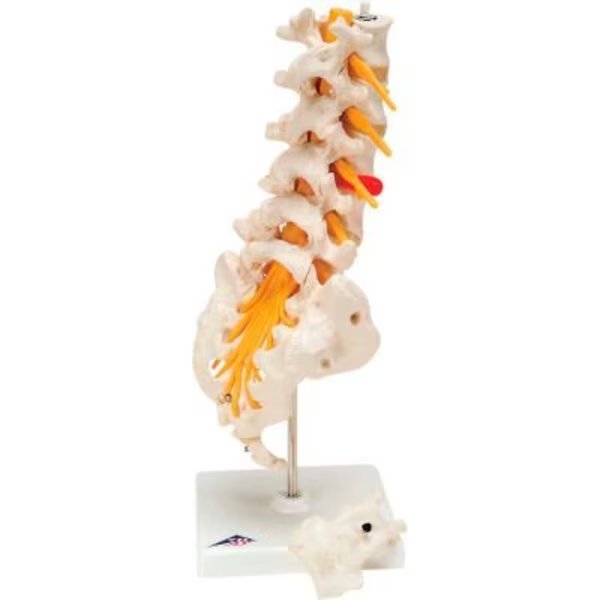 3B® Anatomical Model - Lumbar Spinal Column with Dorso-Lateral Prolapsed Disc, Fabrication Enterprises, Mfr#: 965672