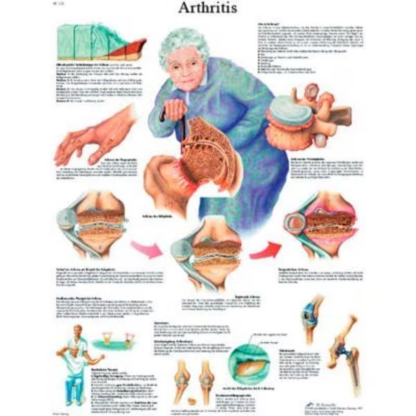 3B® Anatomical Chart - Arthritis, Paper, Fabrication Enterprises, Mfr#: 12-4605P
