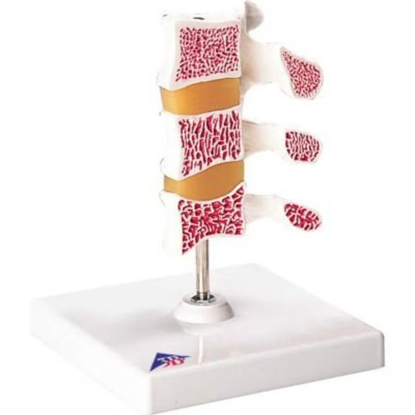 3B® Anatomical Model - Deluxe Osteoporosis (3 Vertebrae), Fabrication Enterprises, Mfr#: 1062096